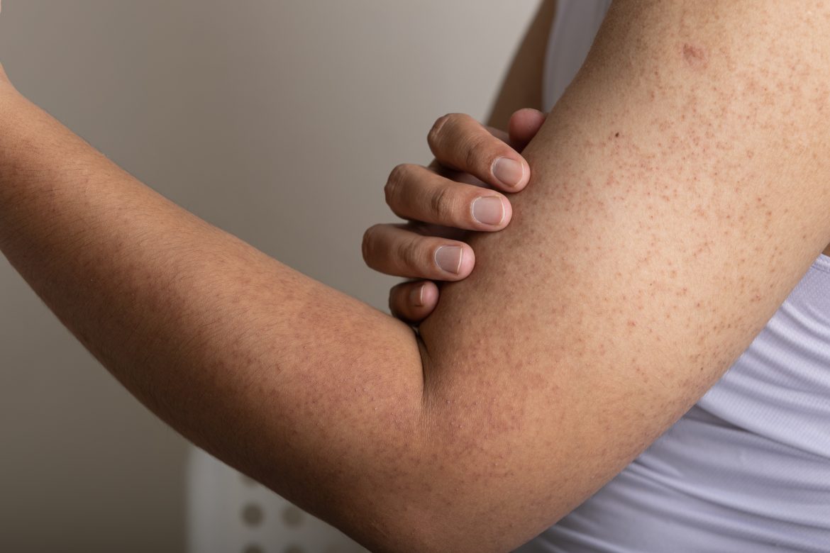Rogowacenie okołomieszkowe – odpowiednia pielęgnacja skóry